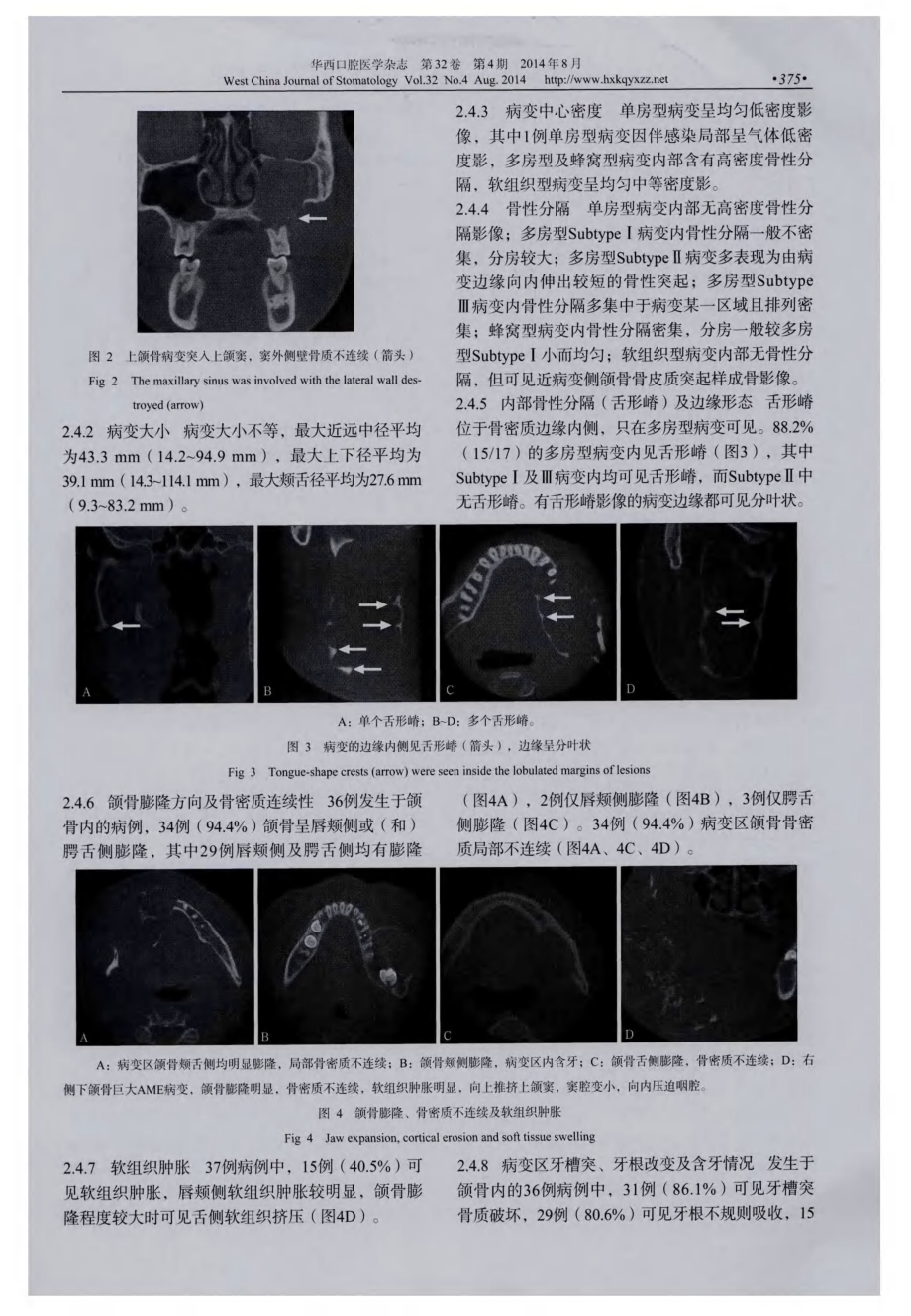 成釉细胞瘤的锥形束CT表现分析.pdf_第3页