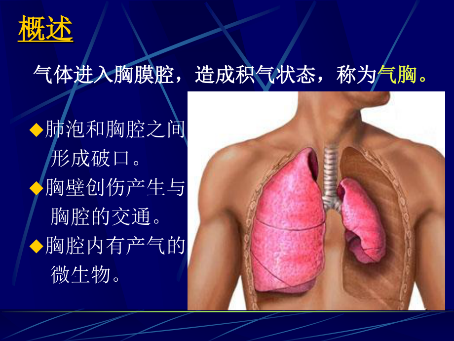 气胸PPT..ppt_第2页