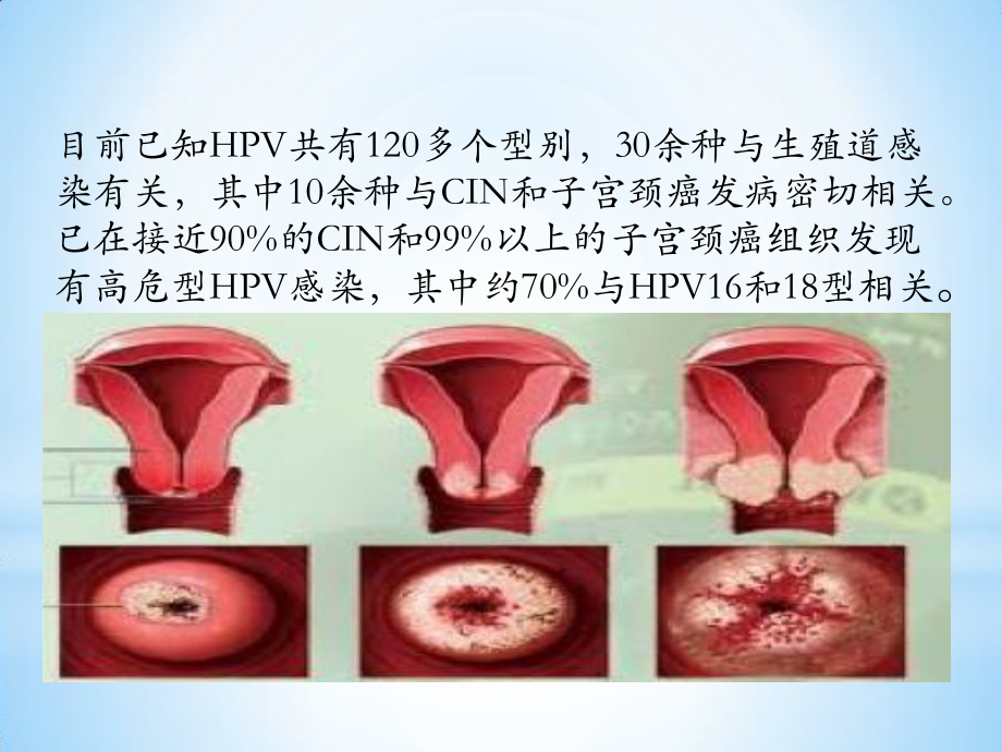 宫颈癌疫苗与HPV.pptx_第3页