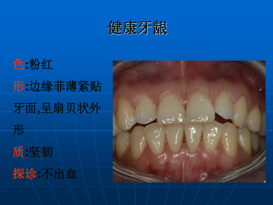 牙周炎知识.ppt_第3页