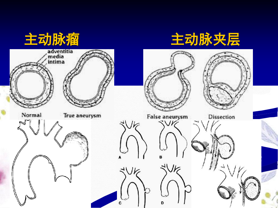 2023年大血管疾病（教学课件）.ppt_第3页