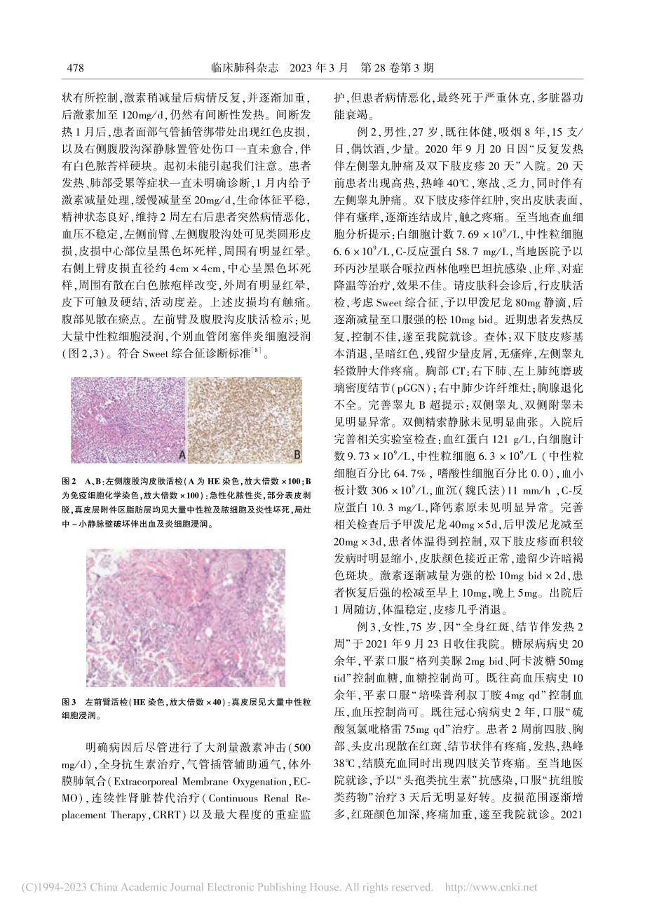 Sweet综合征3例病例报告_徐小燕.pdf_第2页