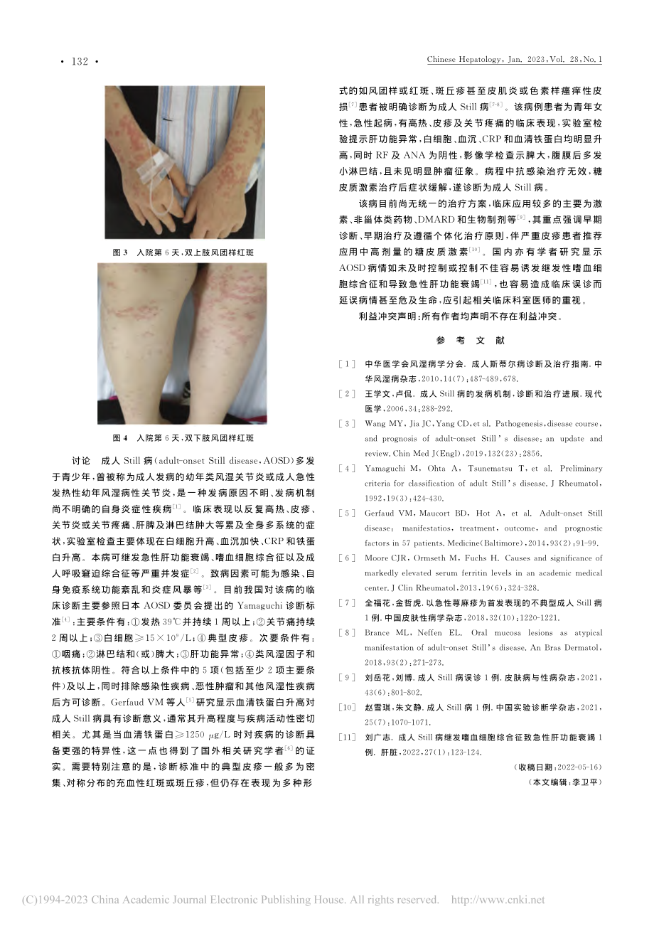 成人Still病合并肝功能衰竭前期误诊1例_王丽惠.pdf_第2页