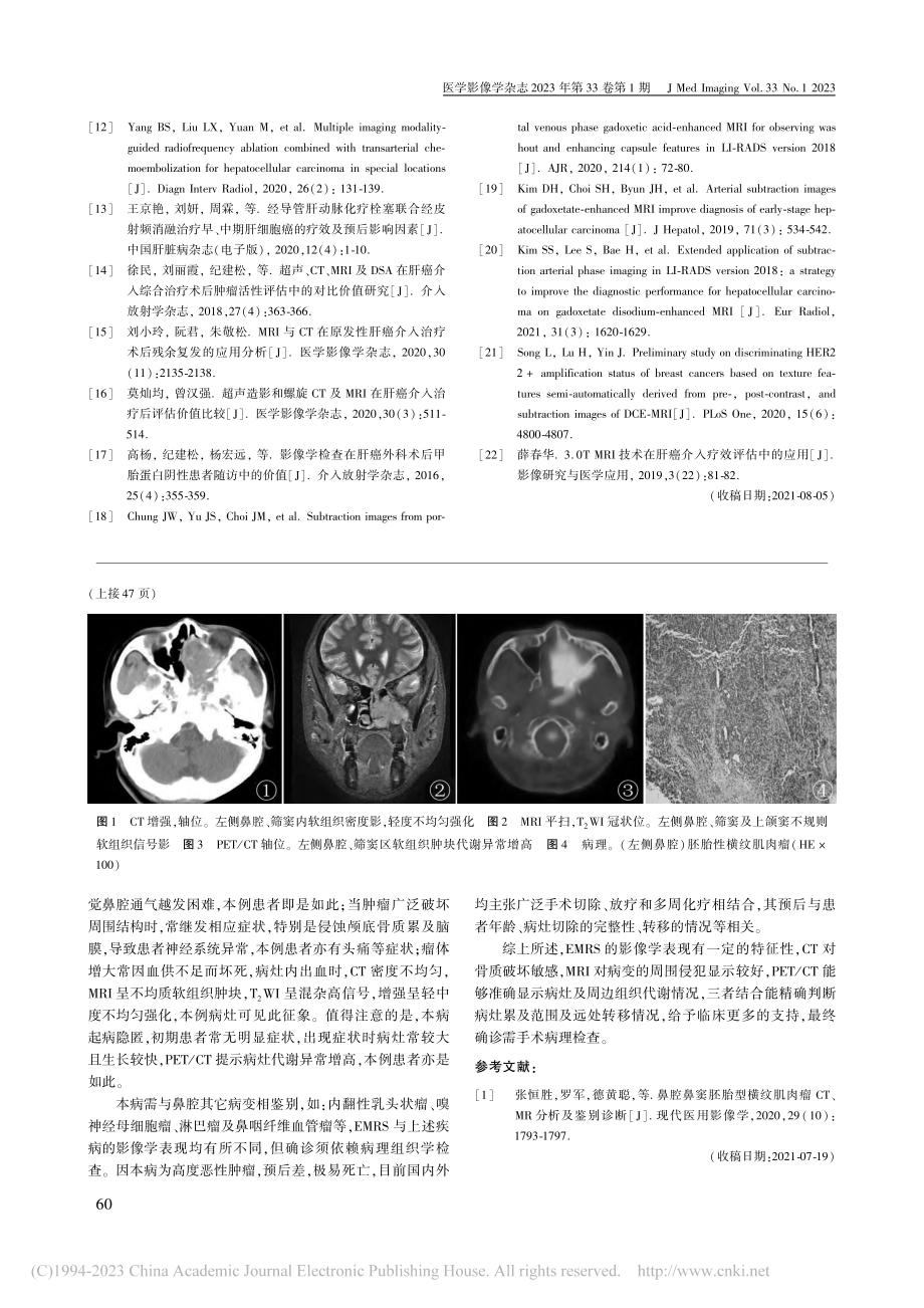 成人鼻腔胚胎性横纹肌肉瘤1例_邹红.pdf_第2页