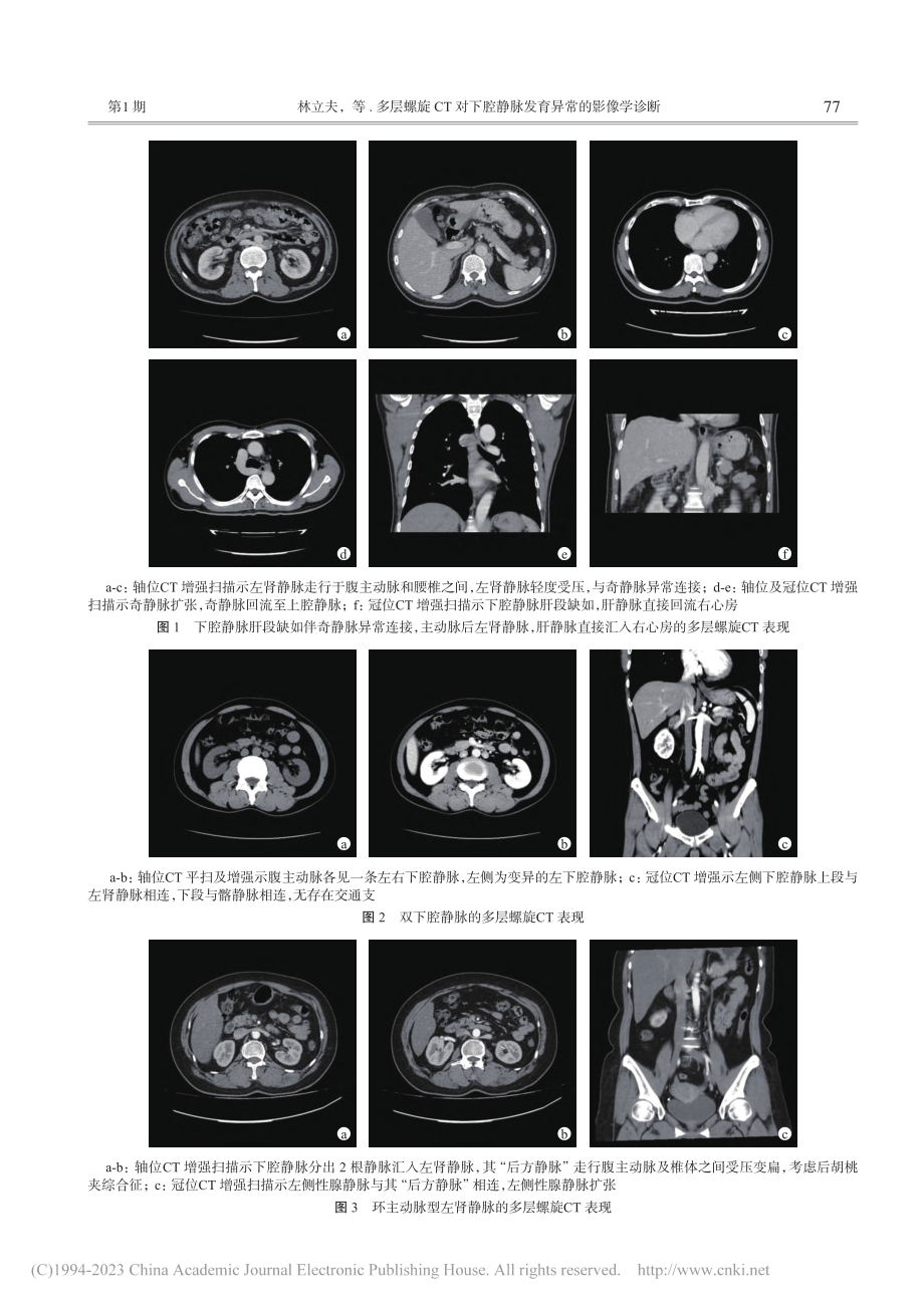 多层螺旋CT对下腔静脉发育异常的影像学诊断_林立夫.pdf_第3页