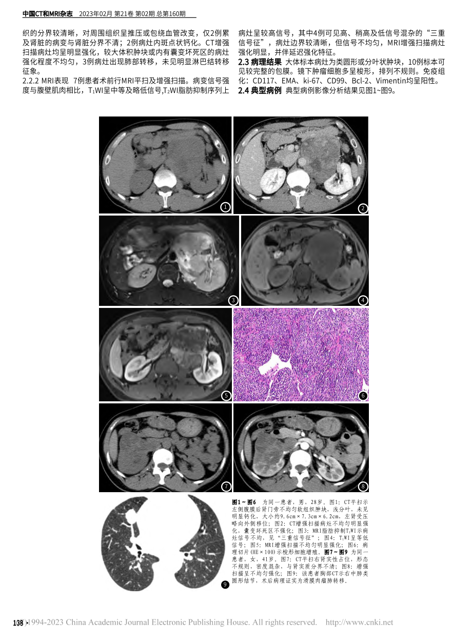 腹盆部滑膜肉瘤的CT、MRI表现与临床病理分析_皮厚山.pdf_第2页