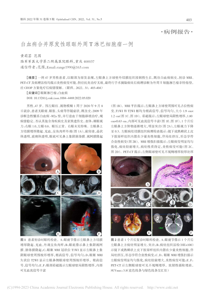 白血病合并原发性眼眶外周T淋巴细胞瘤一例_黄莉芸.pdf_第1页