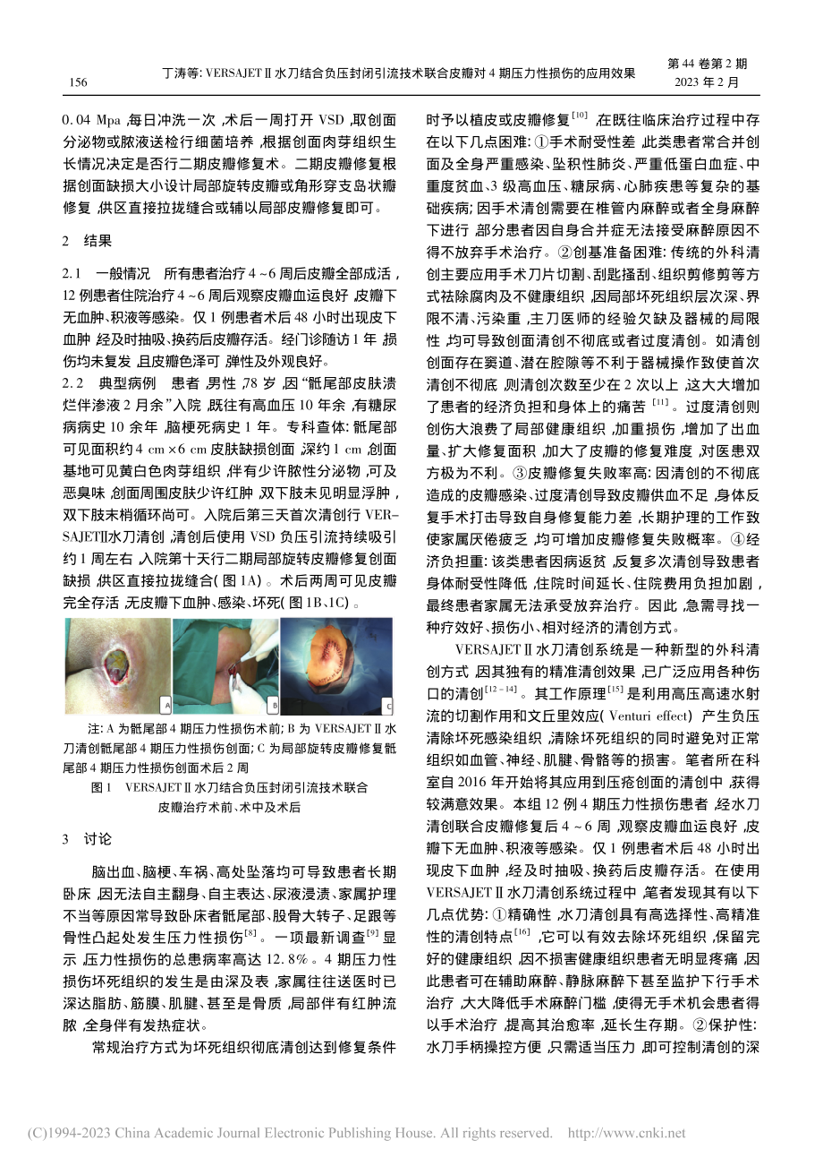 VERSAJETⅡ水刀结合...对4期压力性损伤的应用效果_丁涛.pdf_第2页