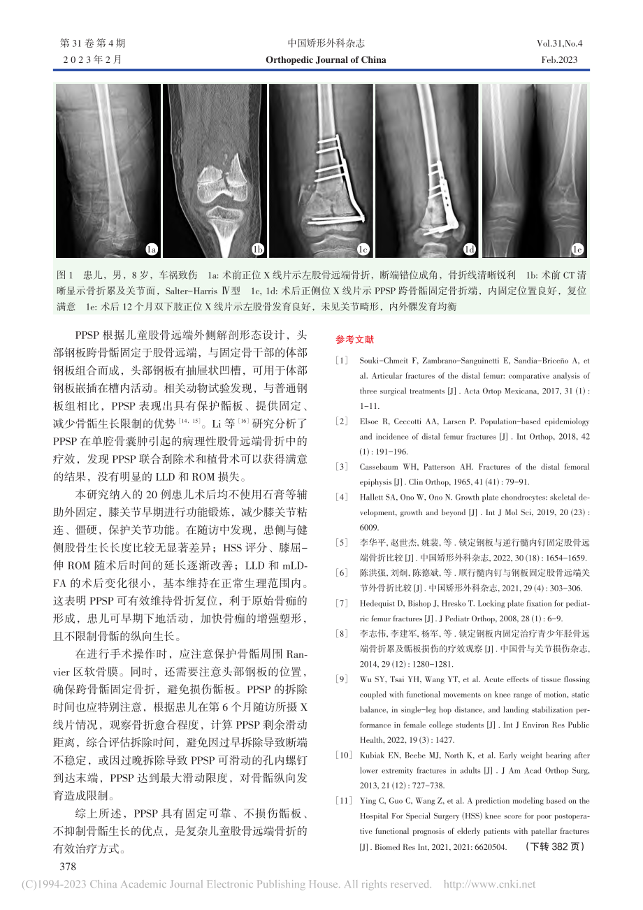 骨骺滑动钢板固定复杂儿童股骨远端骨折_郑浩.pdf_第3页