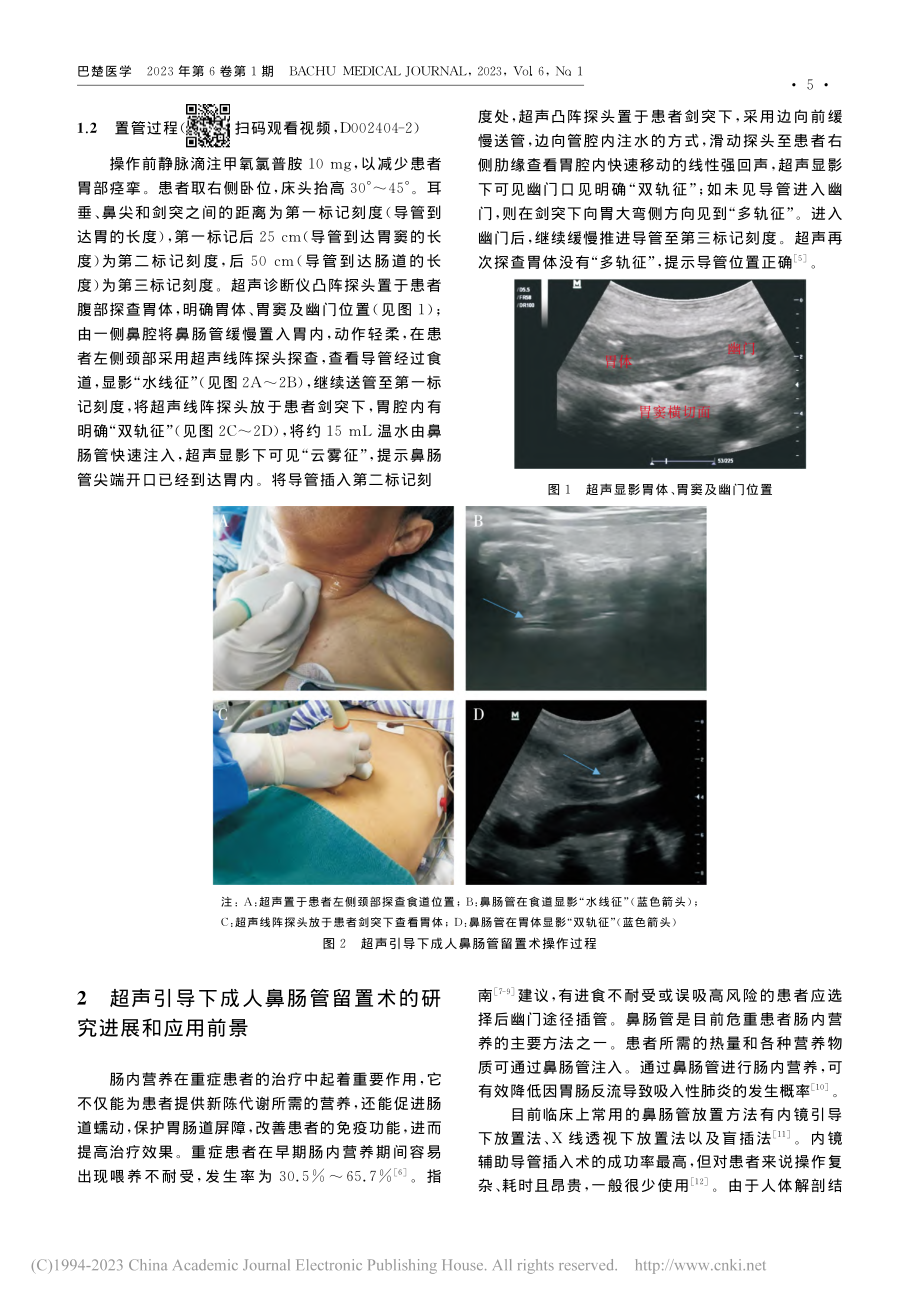 超声引导下成人鼻肠管留置术_彭超.pdf_第2页