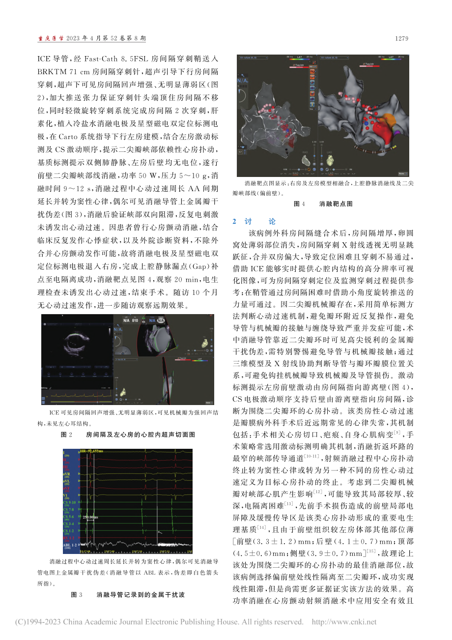 瓣膜病性心房颤动外科消融术后心房扑动消融1例_宾晓红.pdf_第2页