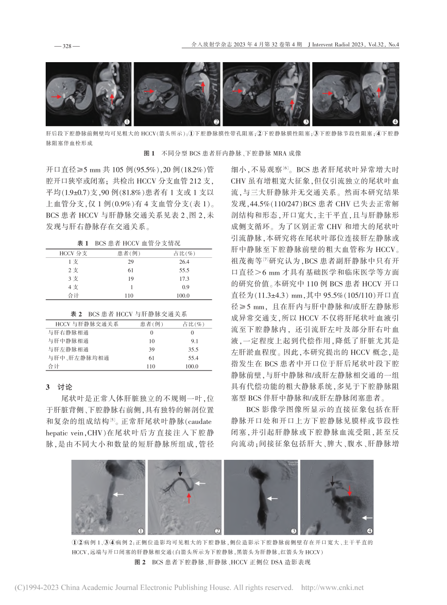 Budd-Chiari综合...者肝尾状叶交通静脉临床意义_潘智阳.pdf_第3页