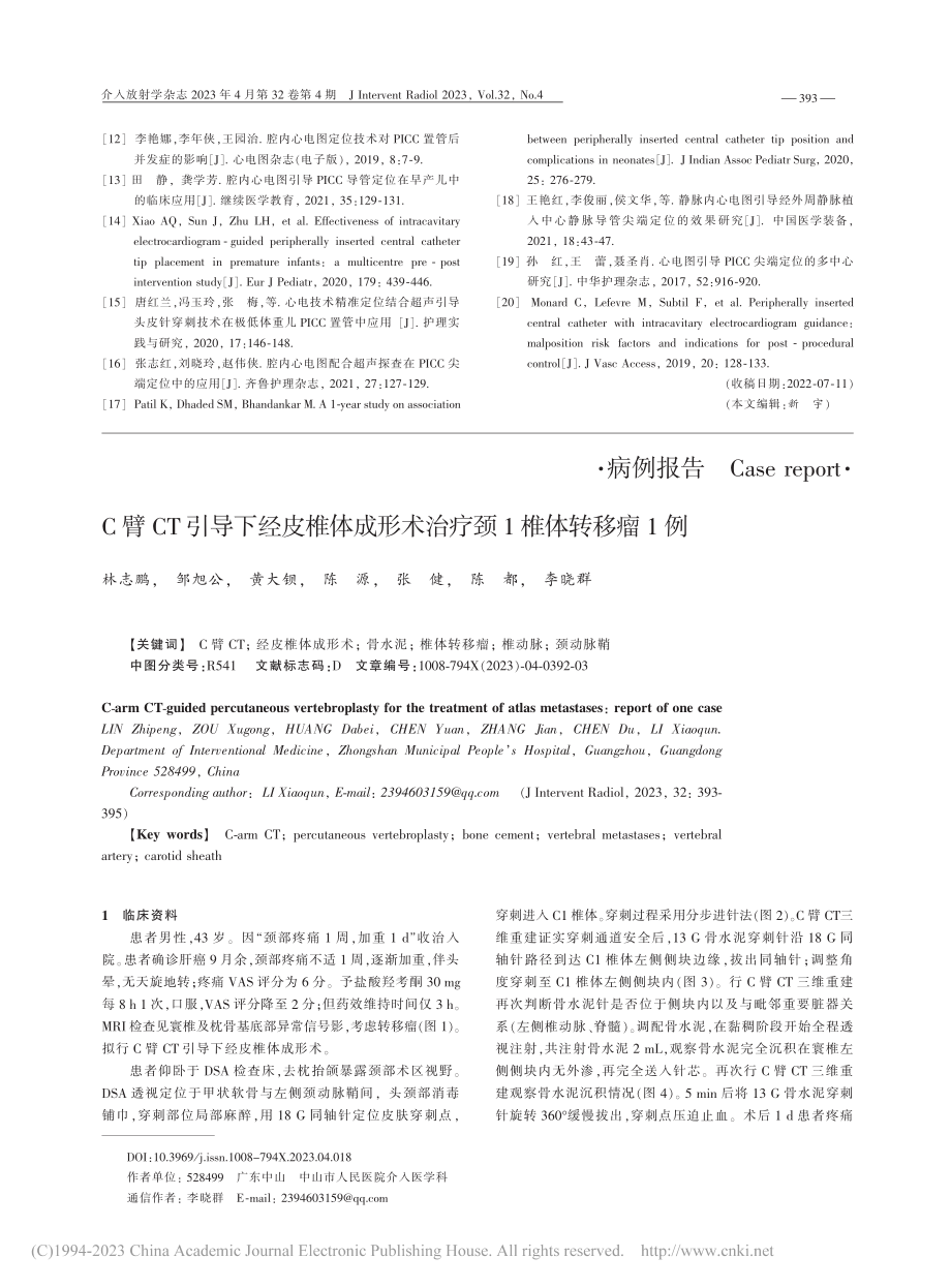 C臂CT引导下经皮椎体成形术治疗颈1椎体转移瘤1例_林志鹏.pdf_第1页