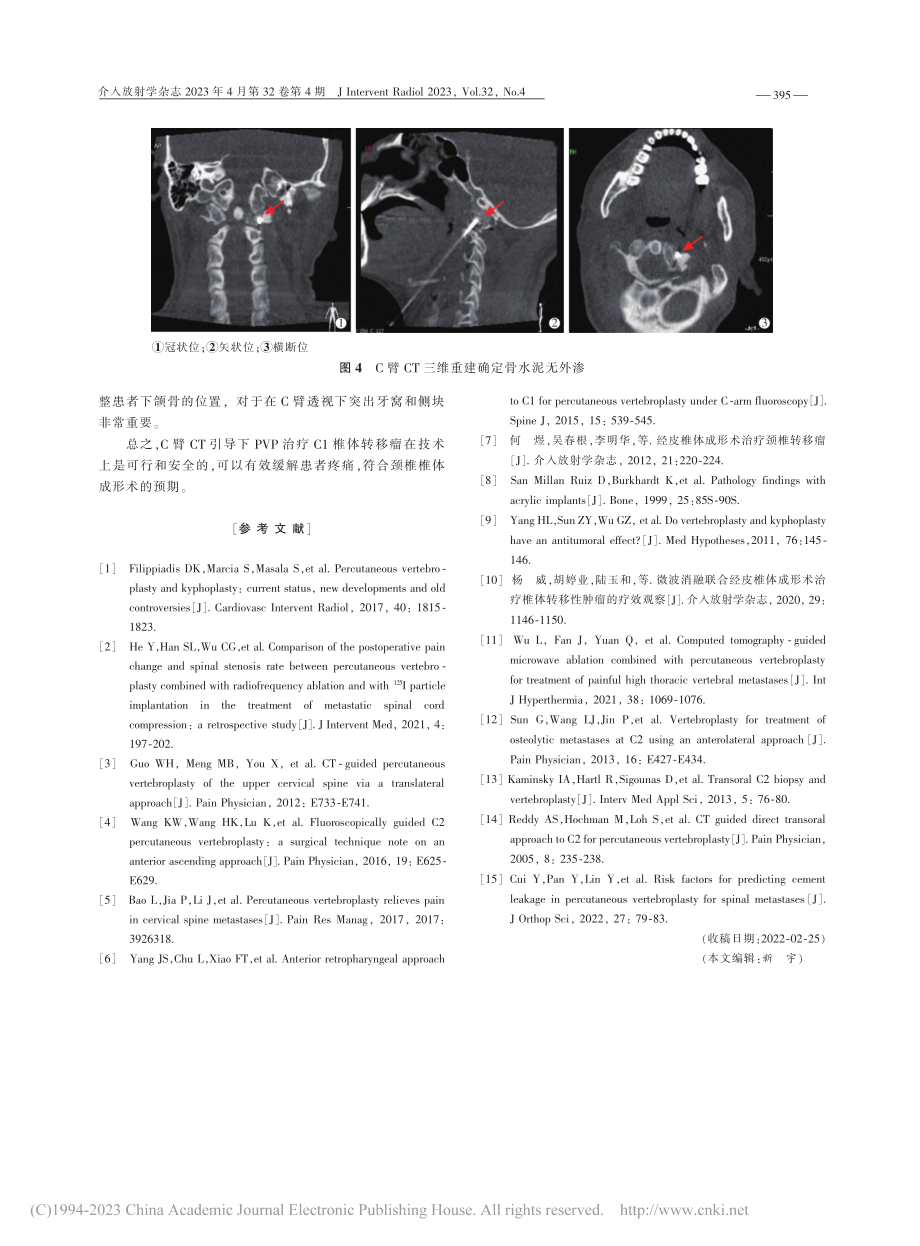 C臂CT引导下经皮椎体成形术治疗颈1椎体转移瘤1例_林志鹏.pdf_第3页