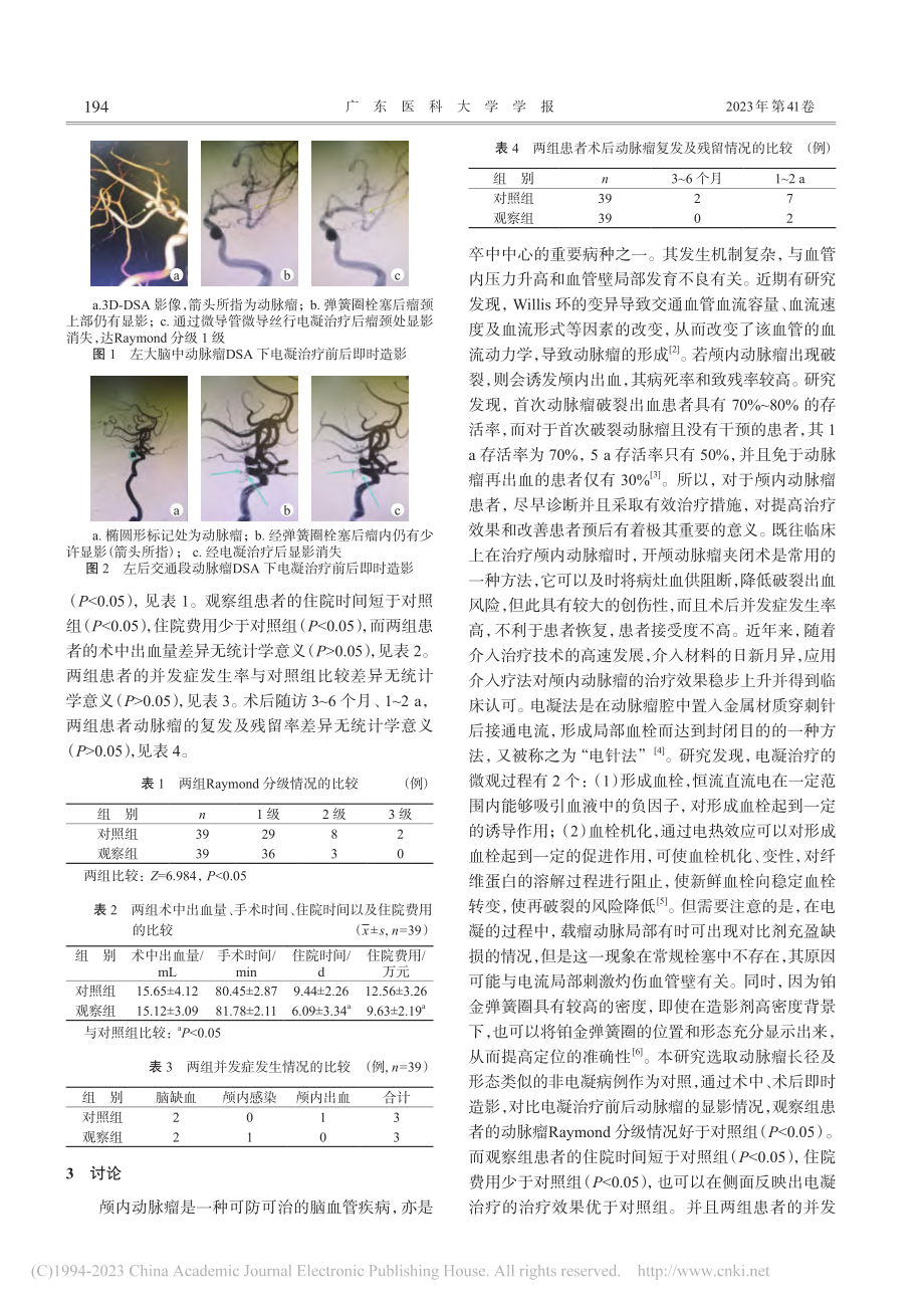 DSA下颅内动脉瘤介入治疗中电凝技术的应用效果_钟云天.pdf_第3页