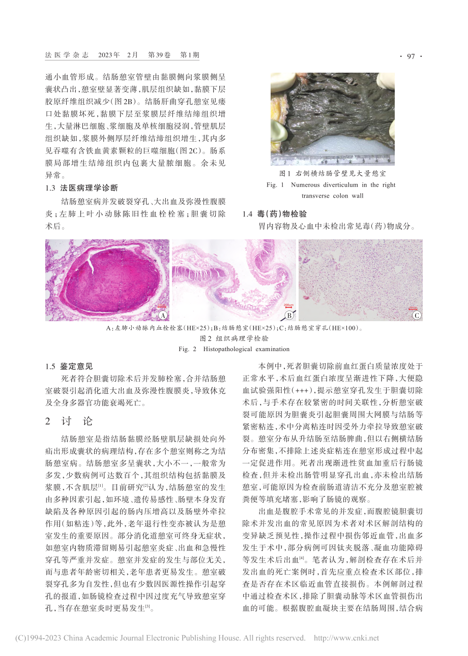 胆囊切除术后并发结肠憩室破裂死亡法医学鉴定1例_邹梦琴.pdf_第2页