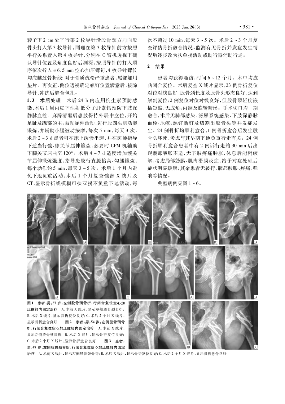 闭合复位空心加压螺钉内固定治疗股骨颈骨折的疗效_孙灵通.pdf_第2页