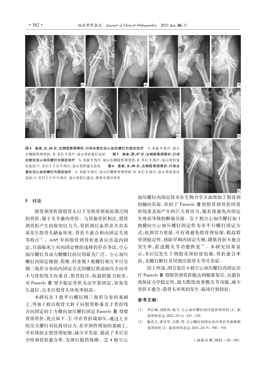 闭合复位空心加压螺钉内固定治疗股骨颈骨折的疗效_孙灵通.pdf_第3页