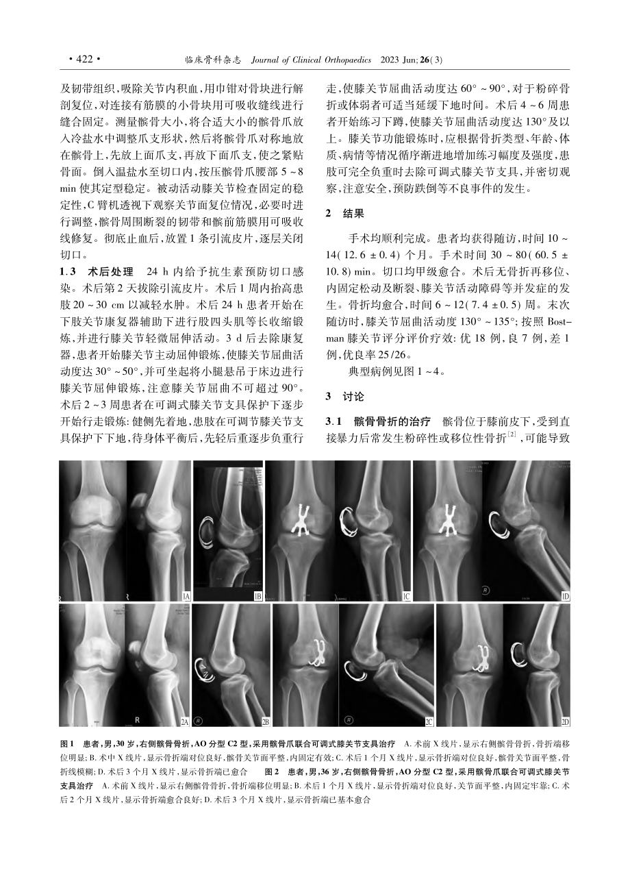 髌骨爪联合可调式膝关节支具治疗髌骨骨折_孙宇.pdf_第2页