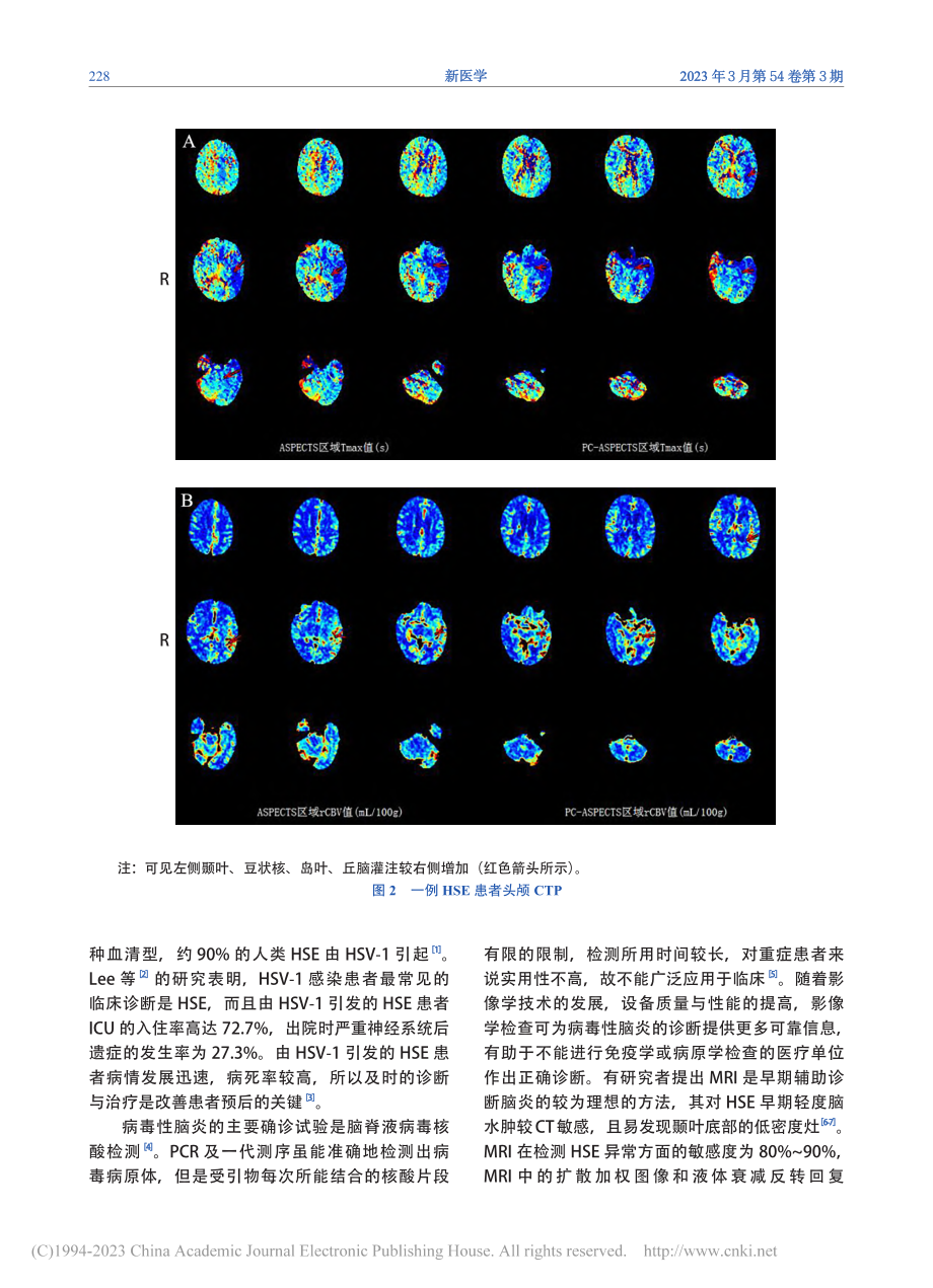 CT灌注成像辅助诊断单纯疱疹病毒1型脑炎一例_符雄琳.pdf_第3页