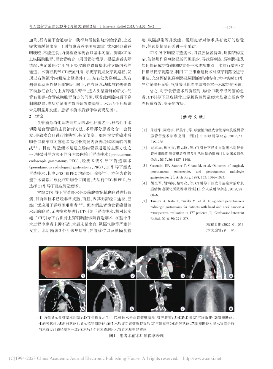 CT引导下经皮锁骨上穿刺胸腔胃造瘘1例_杨崇双.pdf_第2页