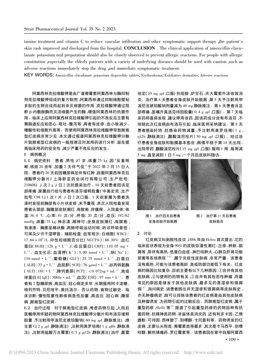 阿莫西林克拉维酸钾致脓疱型红皮病1例及药学监护_刘敏.pdf_第2页