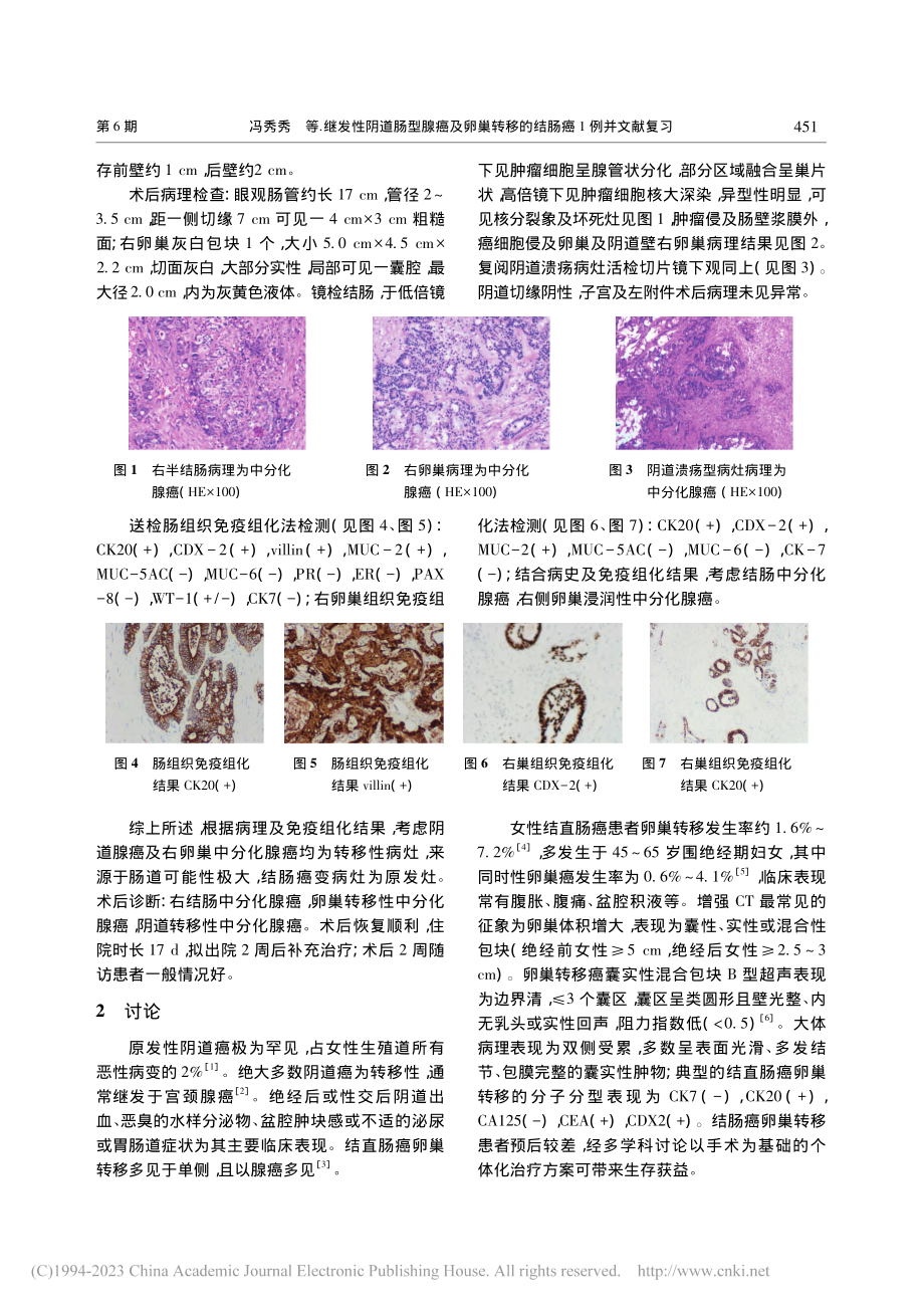 继发性阴道肠型腺癌及卵巢转移的结肠癌1例并文献复习_冯秀秀.pdf_第2页