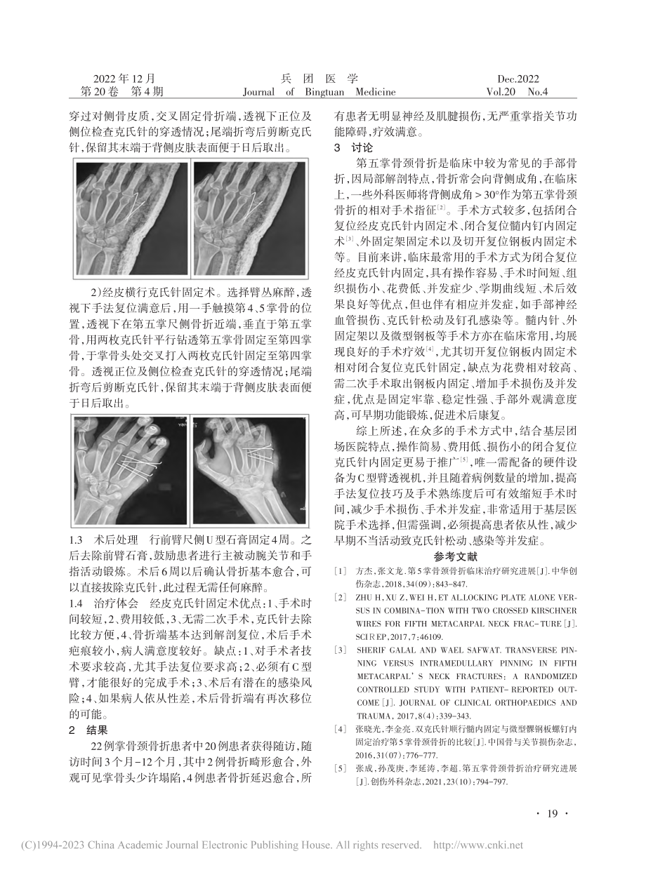 经皮克氏针内固定治疗第五掌骨颈骨折的体会_余剑锋.pdf_第2页