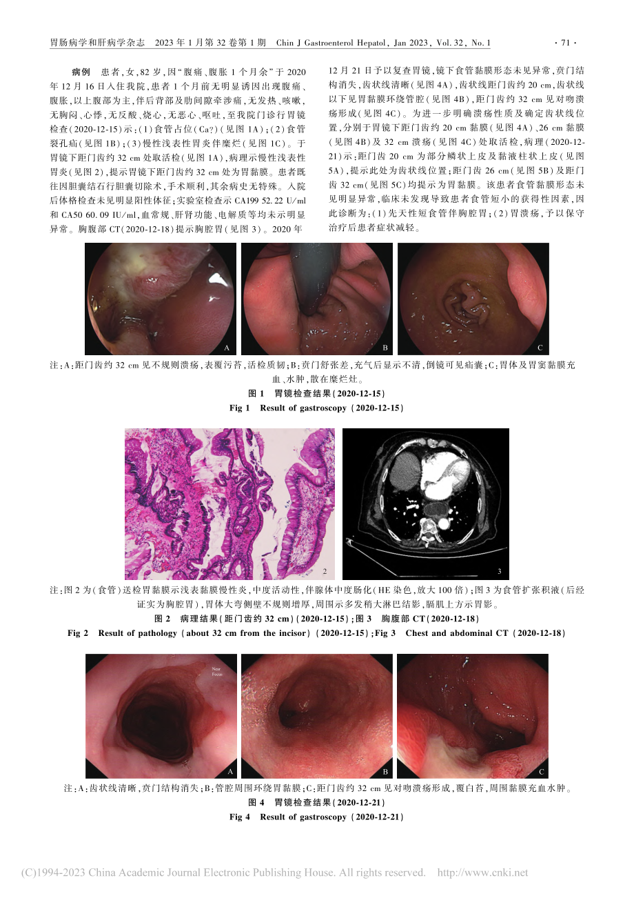 联合胃镜及病理诊断先天性短食管1例报道_阚倩.pdf_第2页