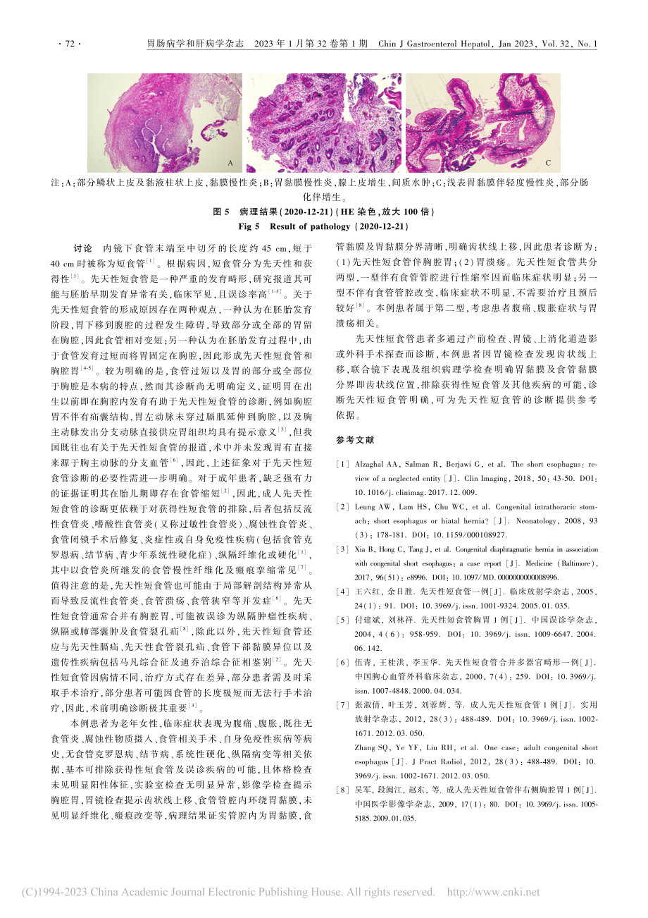 联合胃镜及病理诊断先天性短食管1例报道_阚倩.pdf_第3页