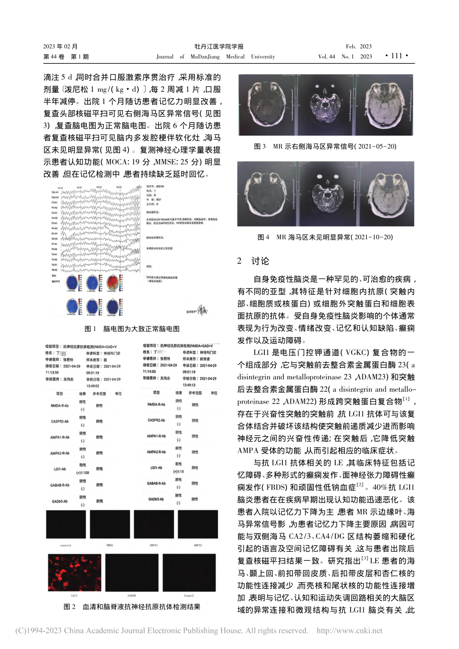 抗LGI-1抗体阳性边缘叶脑炎1例_徐明蔚.pdf_第2页