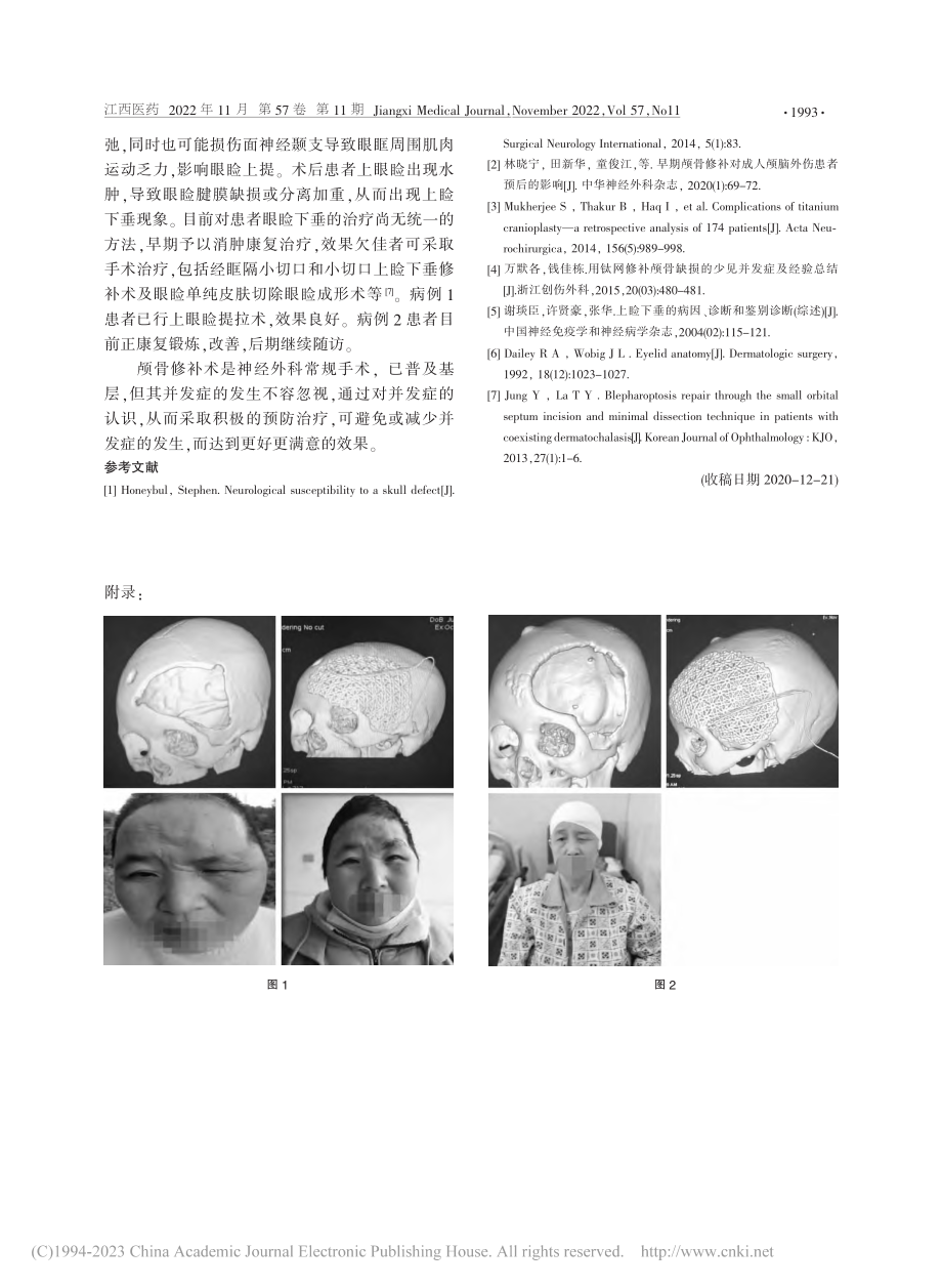 颅骨修补术后眼睑下垂2例_陈丰文.pdf_第2页