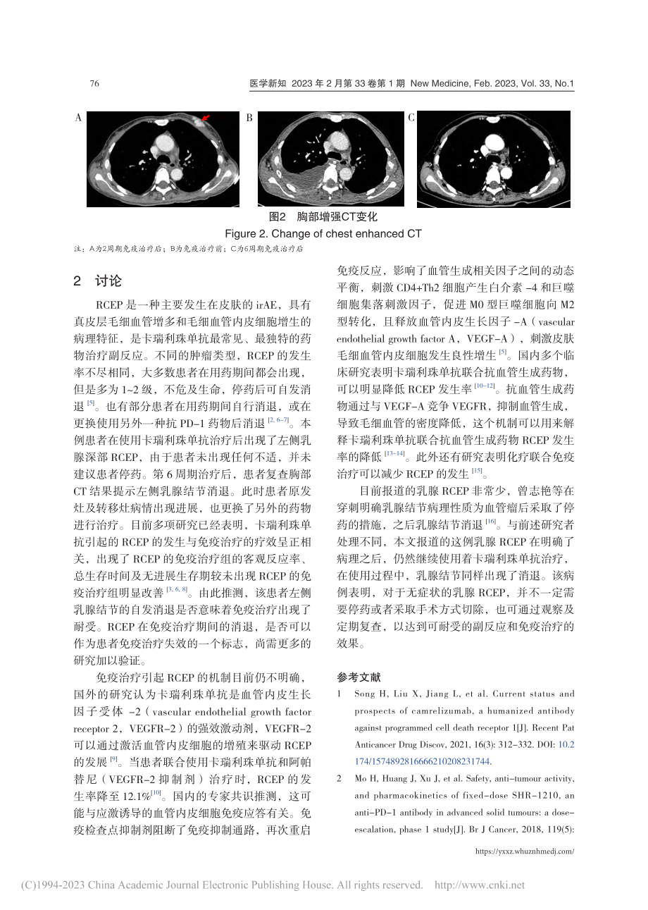 免疫治疗相关乳腺反应性毛细血管增生症1例_揭晨.pdf_第3页