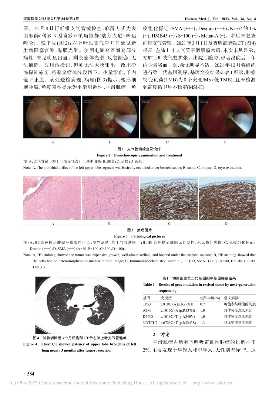 内镜下治疗支气管平滑肌瘤一例_潘婷钰.pdf_第2页