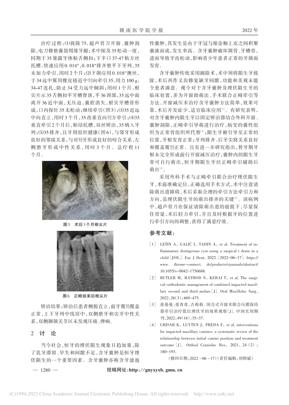 手术结合正畸联合治疗左下颌骨含牙囊肿1例_张秋芳.pdf_第2页