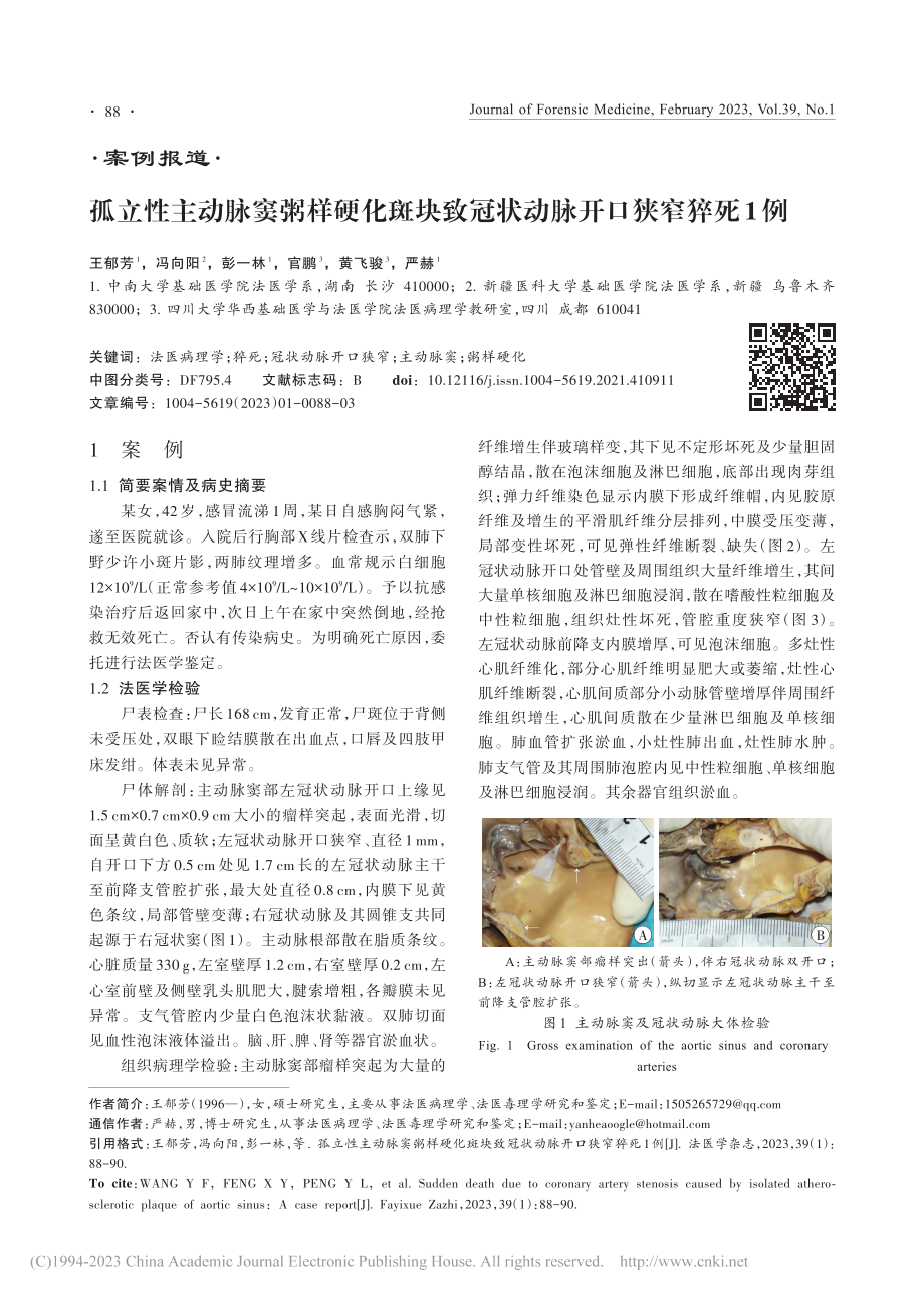 孤立性主动脉窦粥样硬化斑块致冠状动脉开口狭窄猝死1例_王郁芳.pdf_第1页