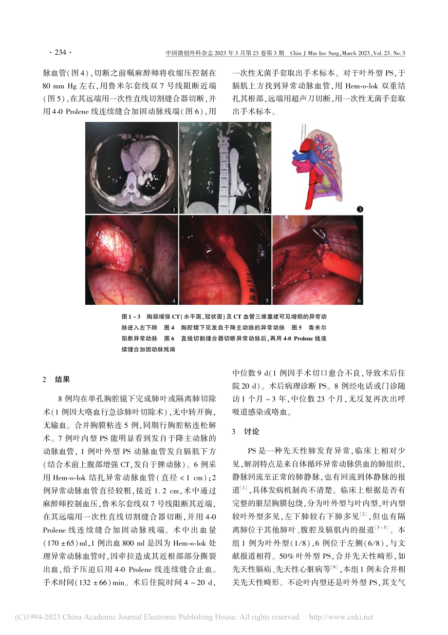 单孔胸腔镜手术治疗肺隔离症8例_陈世雄.pdf_第2页