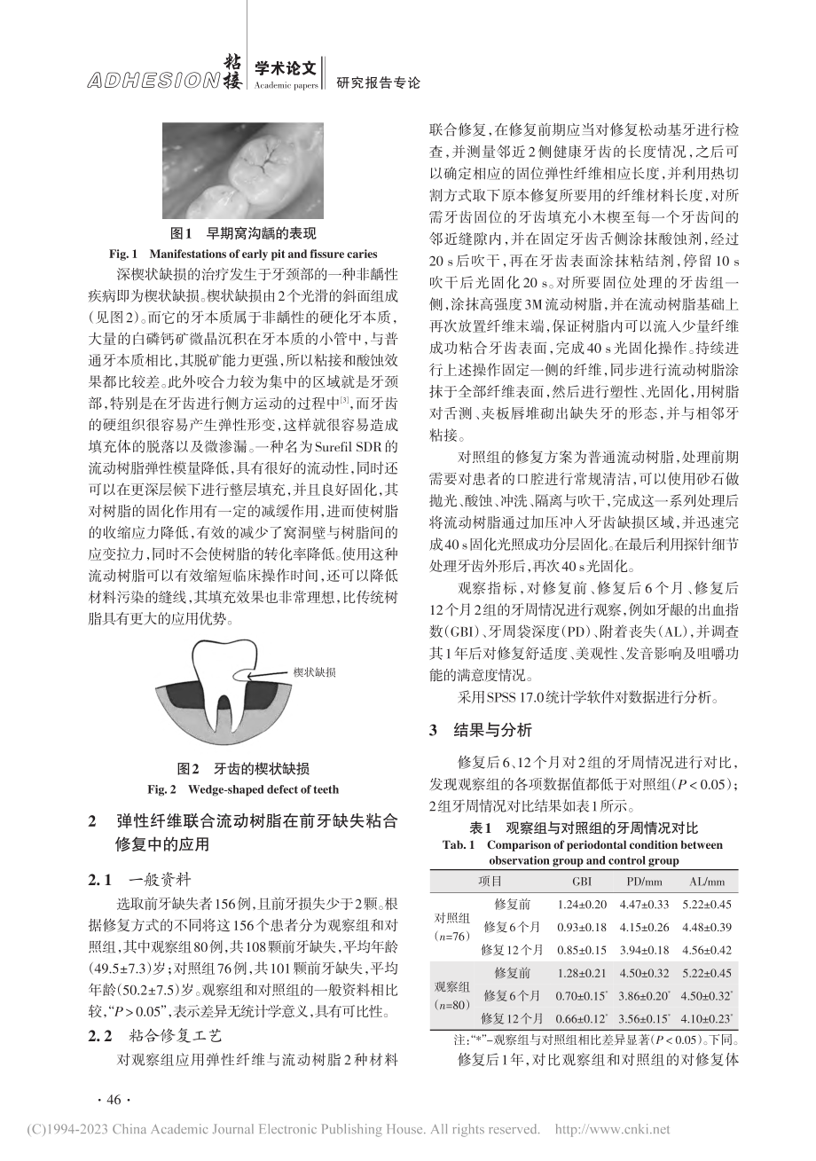 弹性纤维联合流动树脂在前牙缺失粘合修复中的应用_段丽娜.pdf_第3页