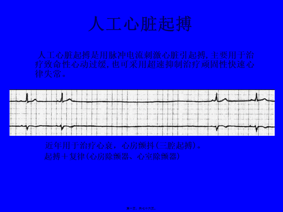 人工心脏起搏03417ppt.pptx_第1页