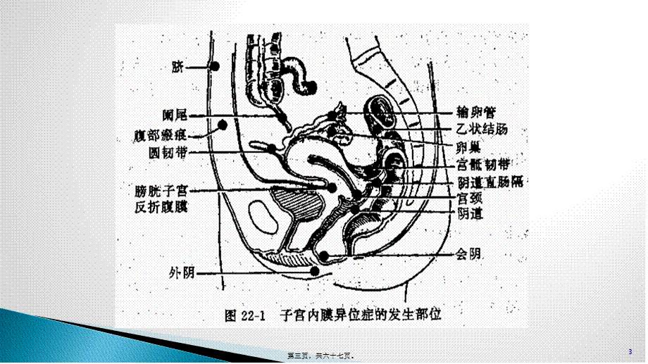 子宫内膜异位.pptx_第3页