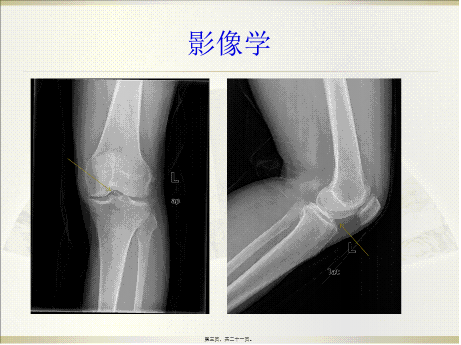 前交叉韧带胫骨止点撕脱性骨折.pptx_第3页