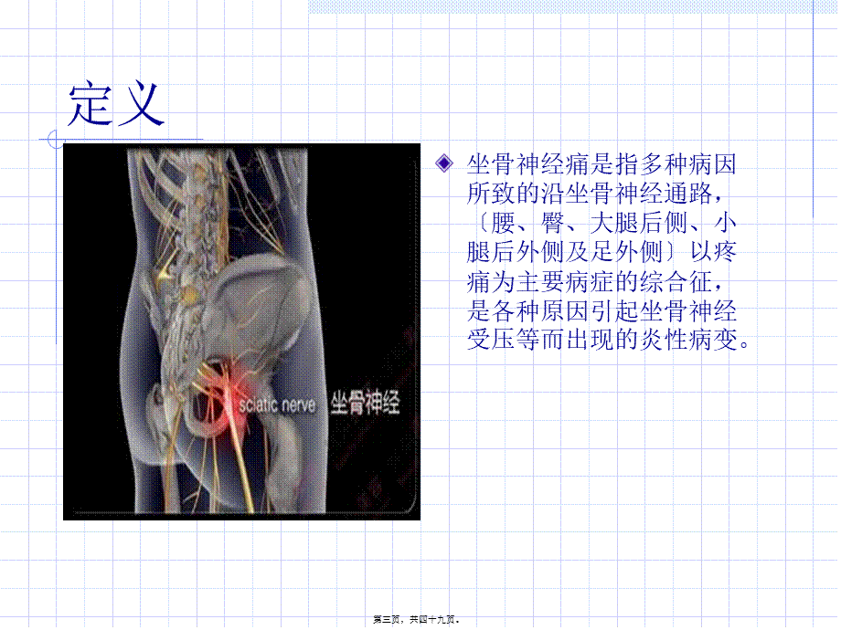 坐骨神经痛.pptx_第3页