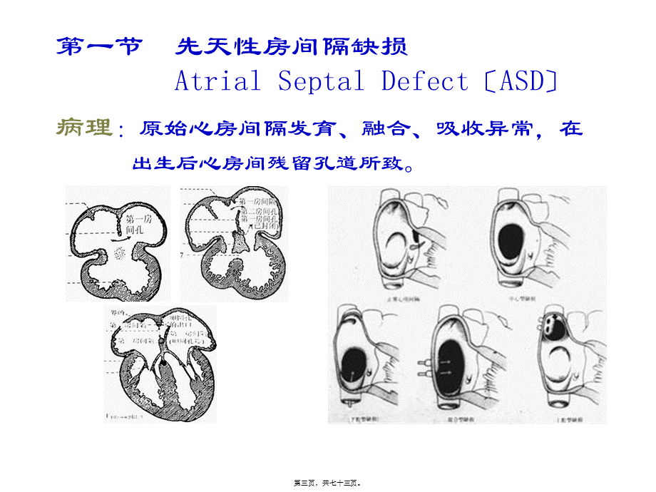 先天性心血管病(精).pptx_第3页