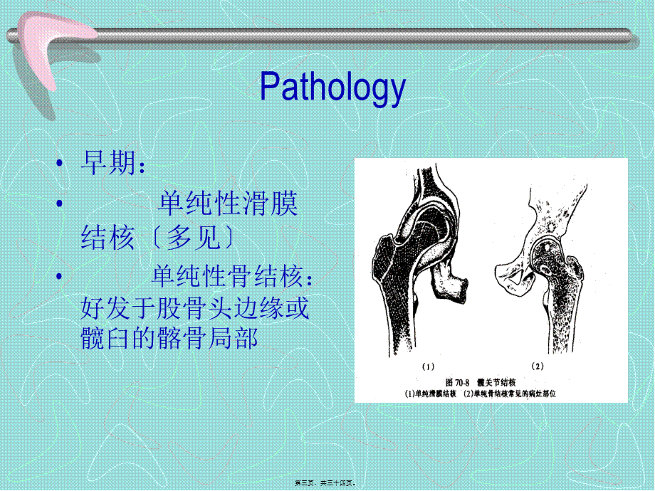 同种异体骨移植在骨科的应用.pptx_第3页