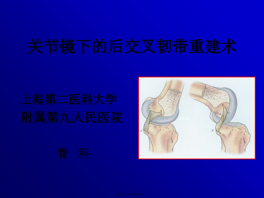 关节镜下的后交叉韧带重建术.pptx_第1页