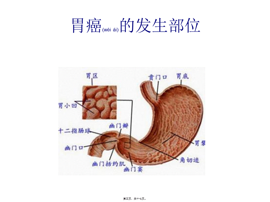 2022年医学专题—胃癌常见手术方式(1).ppt_第3页