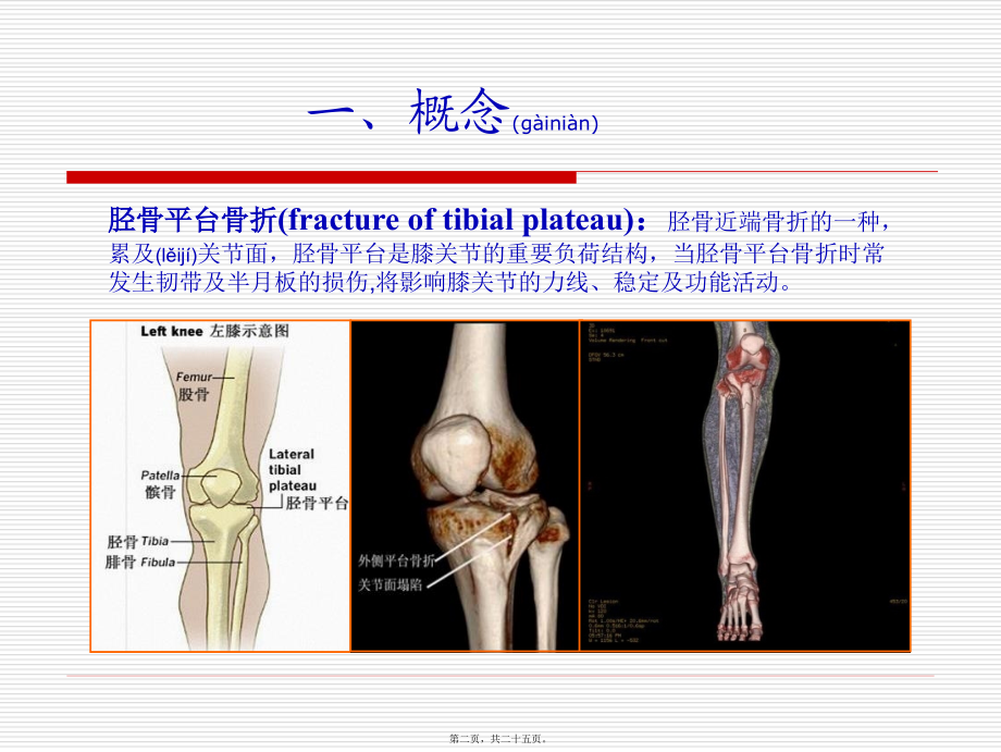 2022年医学专题—胫骨平台骨折fractureoftibialplateau.ppt_第2页