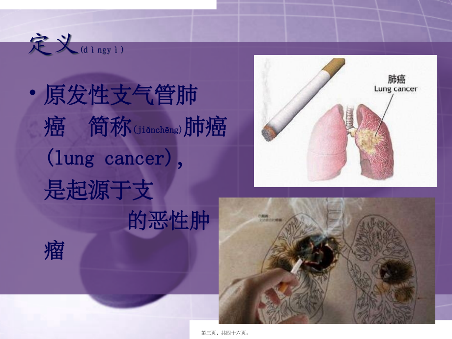 2022年医学专题—第八节原发性支气管肺癌2(1).ppt_第3页