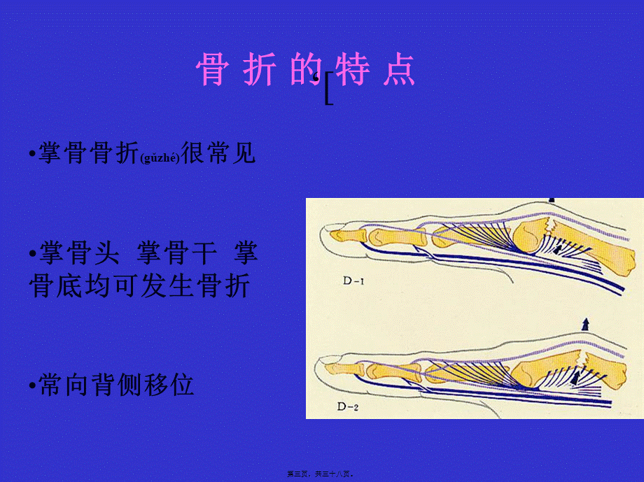 2022年医学专题—掌骨骨折(1).ppt_第3页