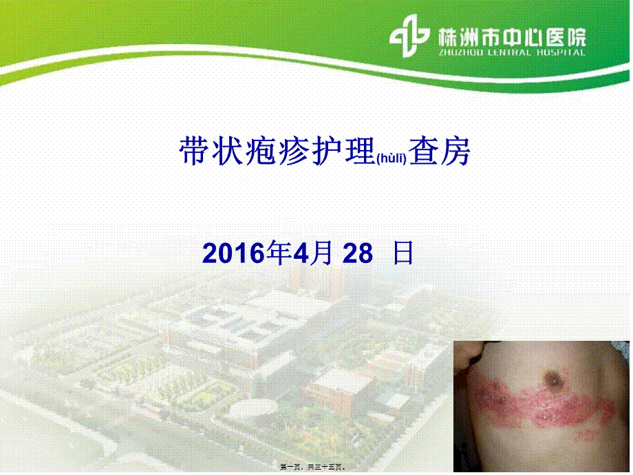 2022年医学专题—带状疱疹查房(1).ppt_第1页